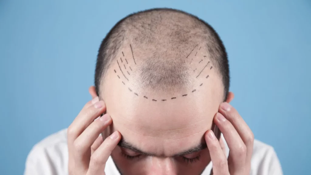 what is fue hair transplant