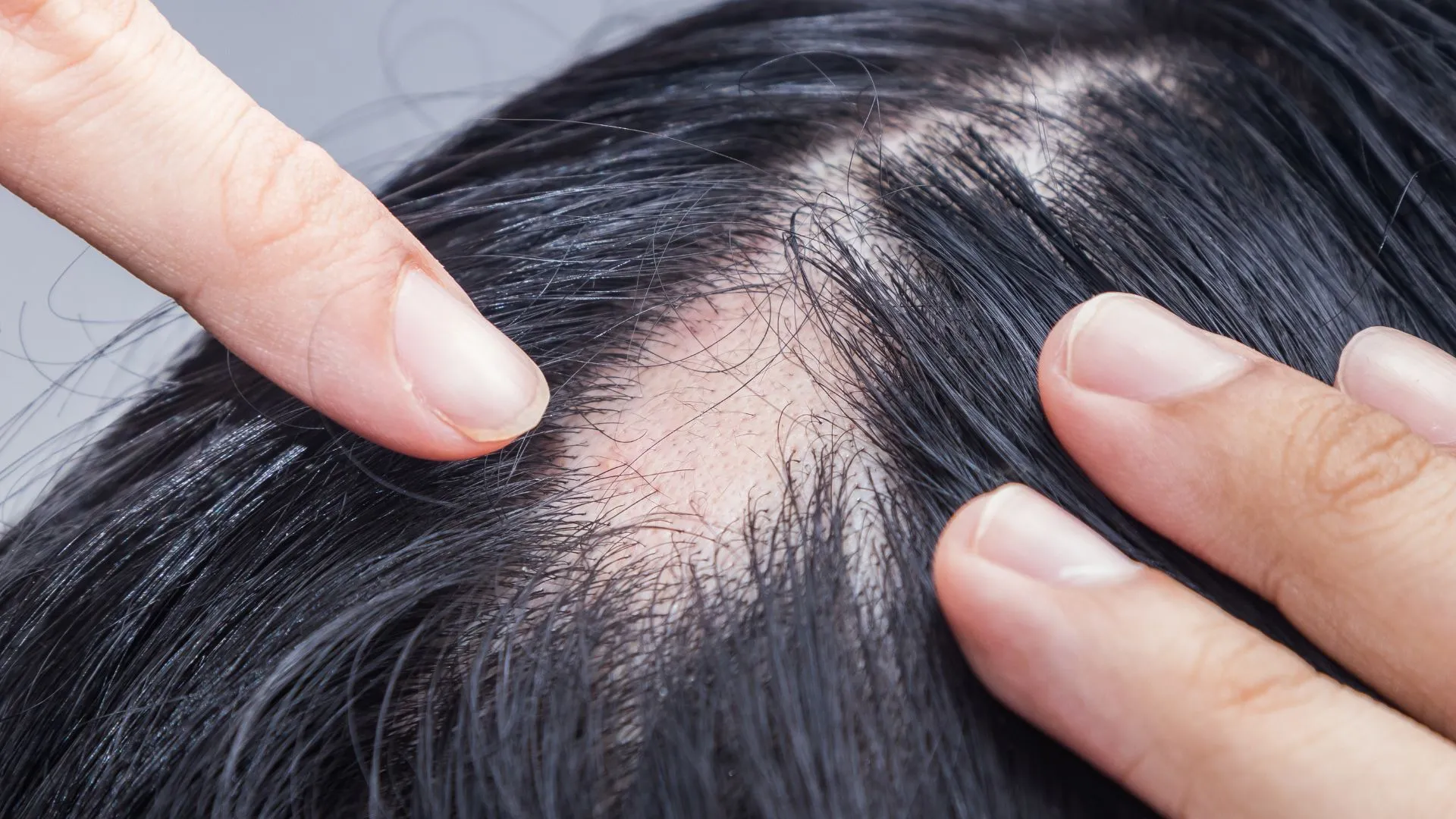 what is Senescent alopecia