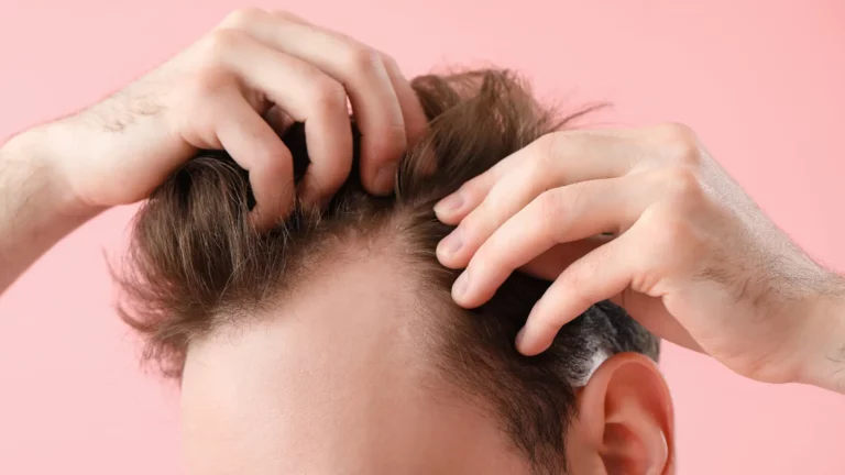 bio fue hair transplant