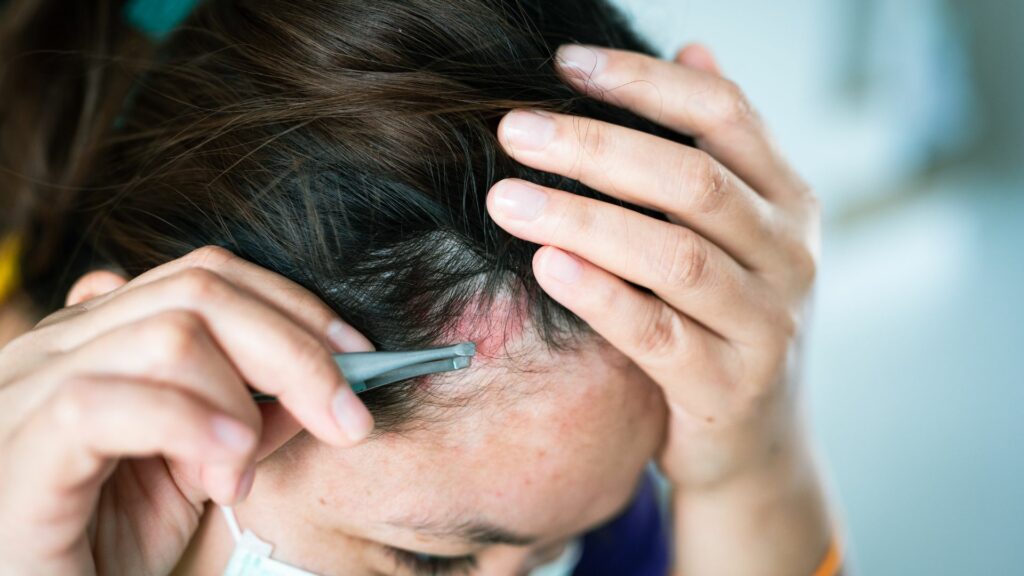 Scabs After Hair Transplant