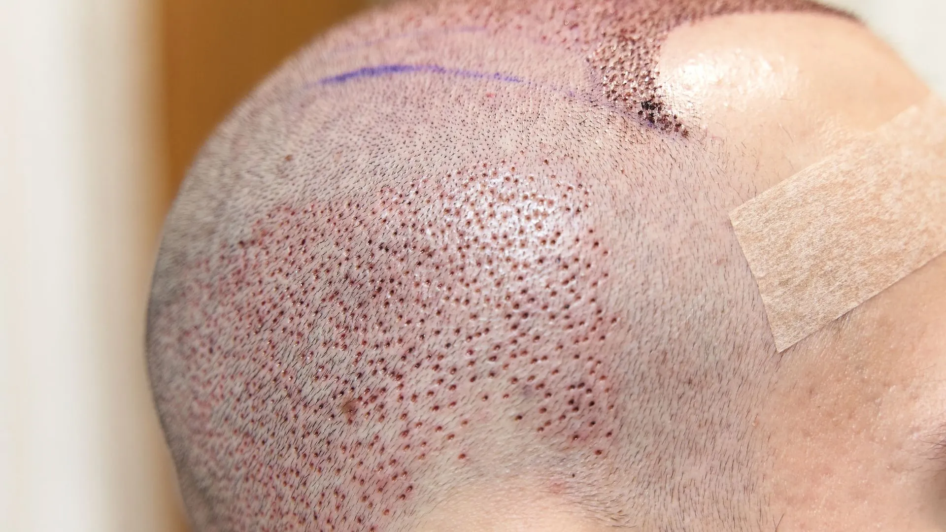 swelling after hair transplant