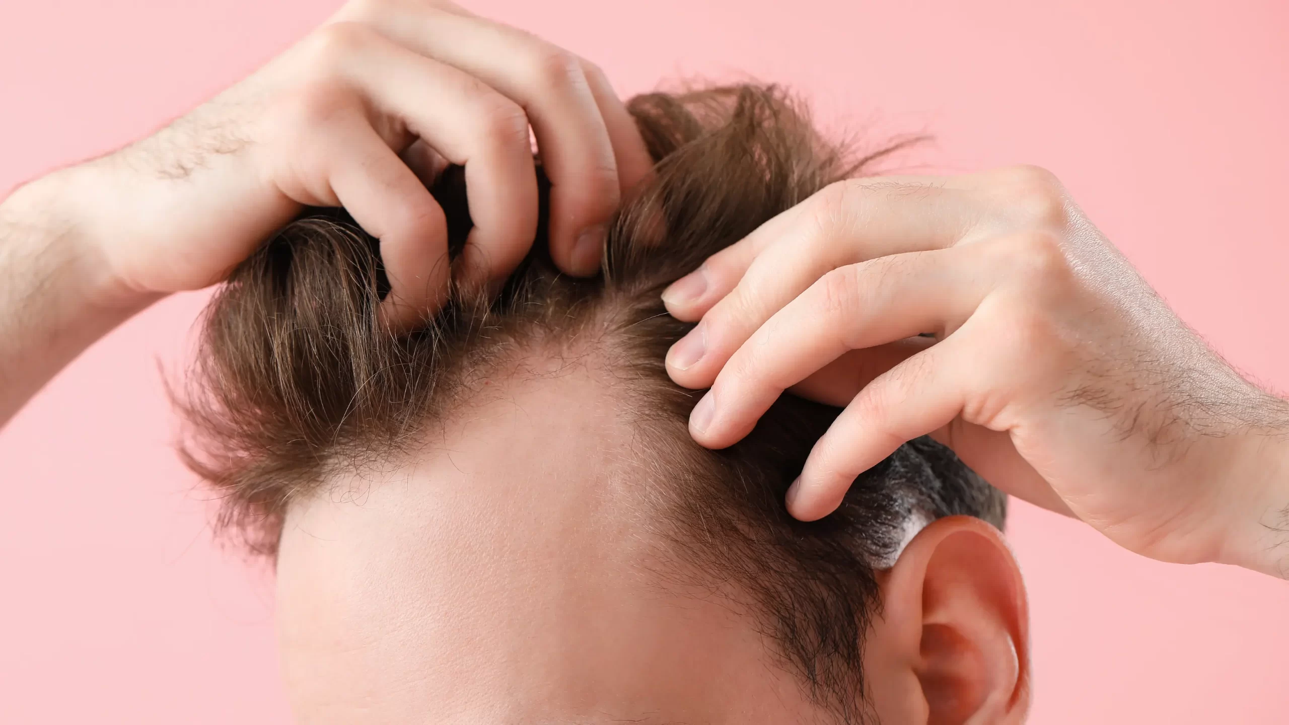 hair transplant ugly duckling phase