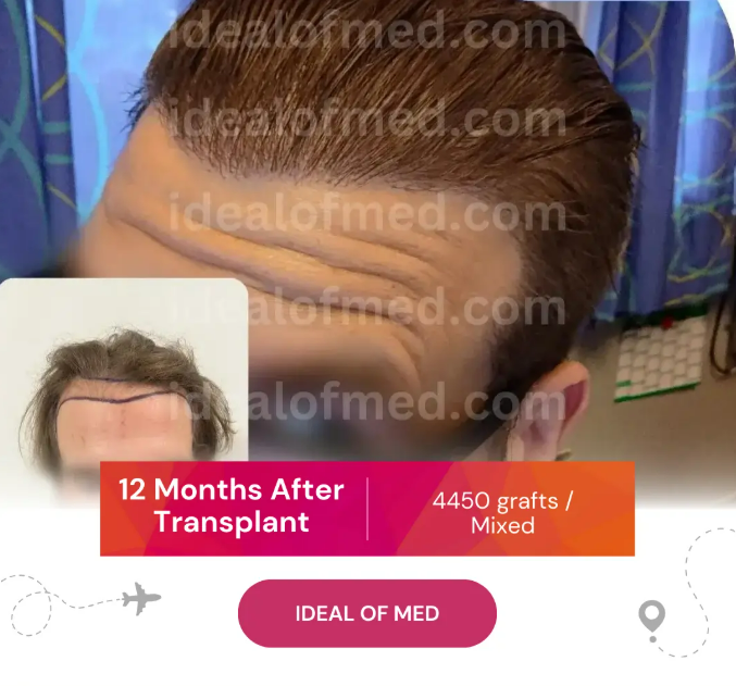12 months after hair transplant