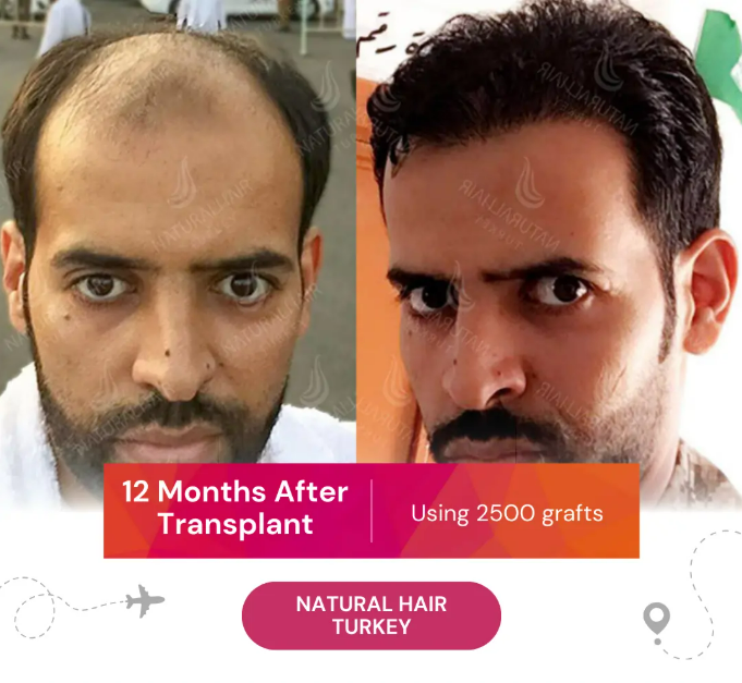 12 months after hair transplant