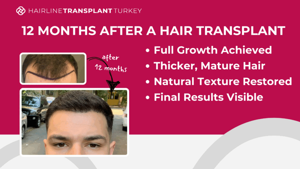 12 months after hair transplant - here is what to expect one year after your hair transplant