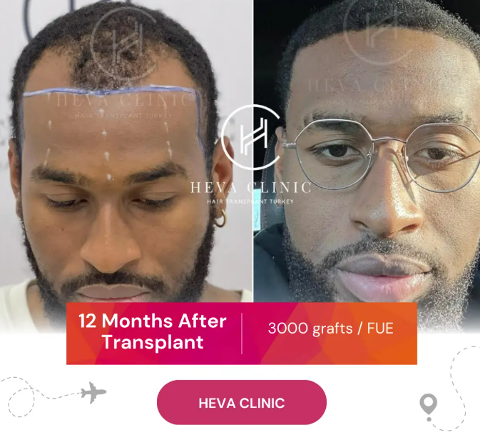 12 months after hair transplant