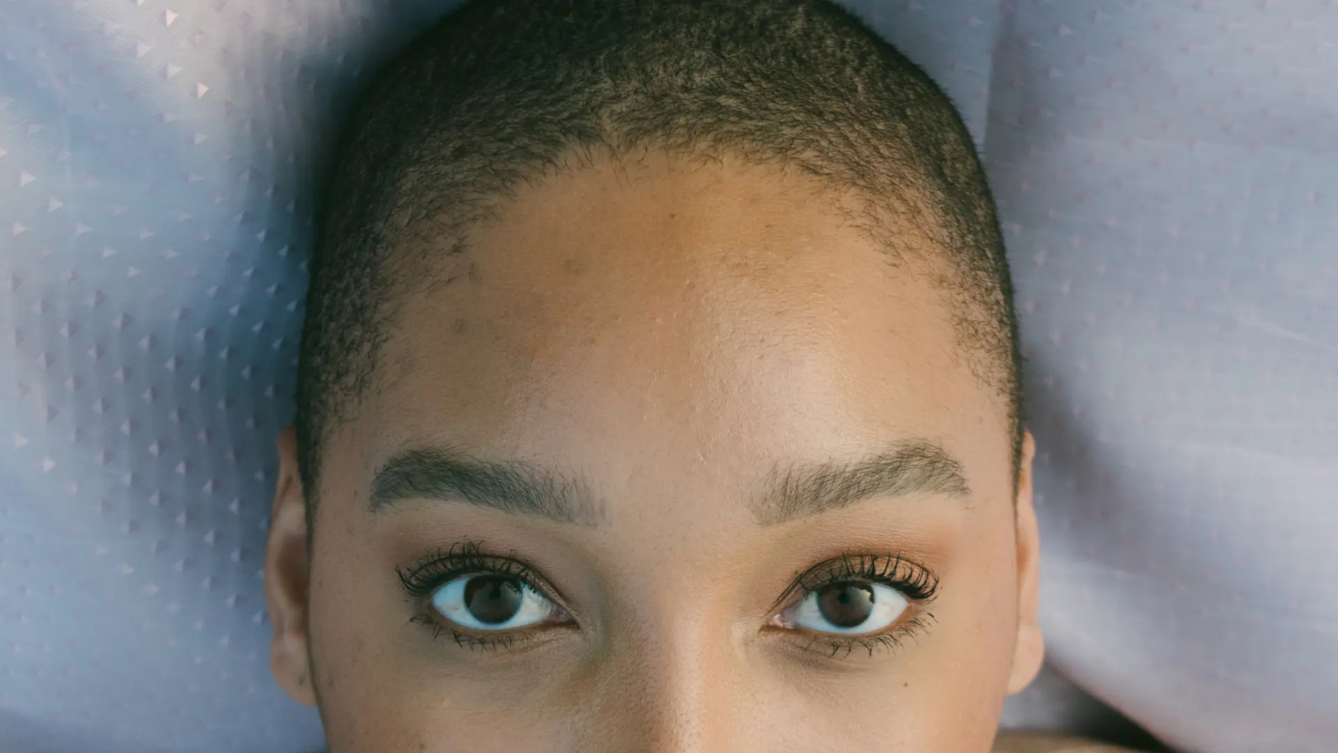 female pattern baldness