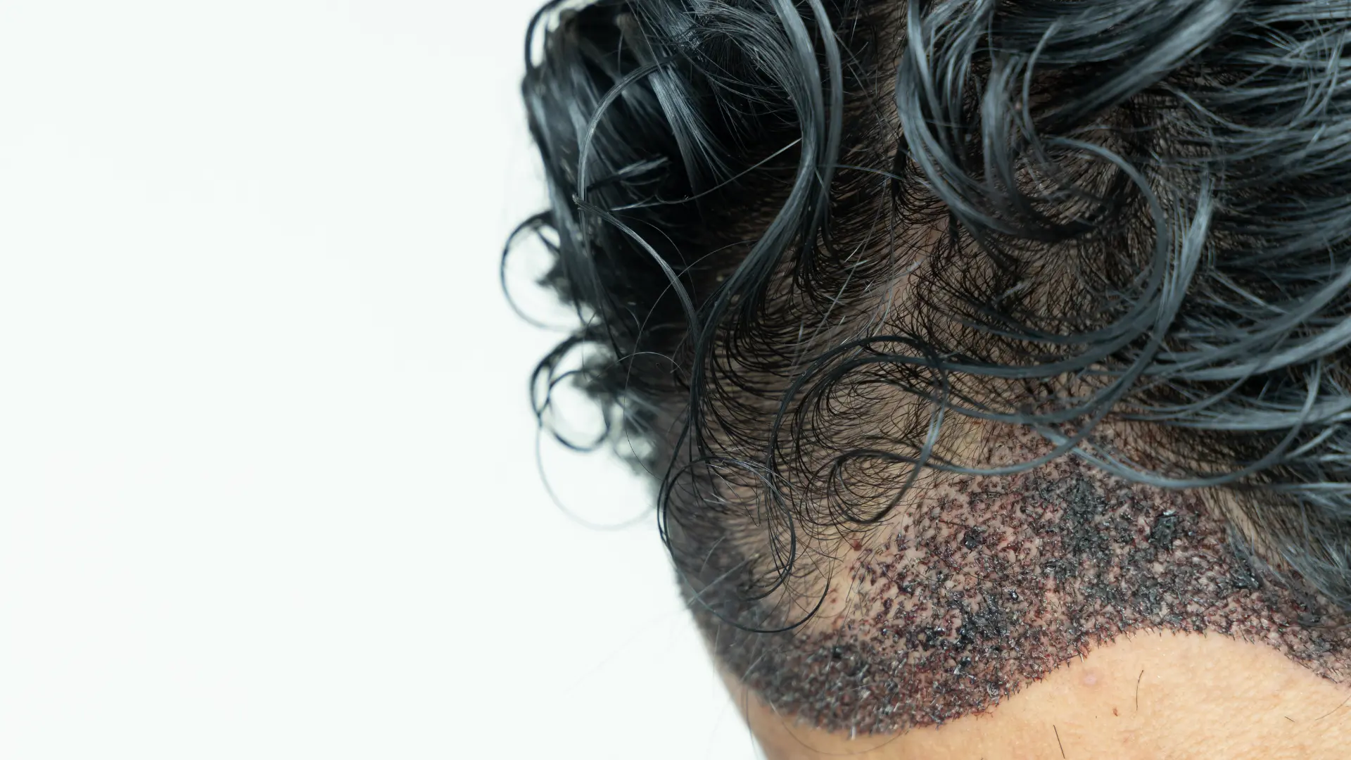 Understanding the Different Types of Hair Transplant Techniques: Which Is Right for You?