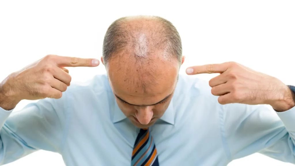 Alternative Solutions to Hair Loss for Those with Autoimmune Disorders