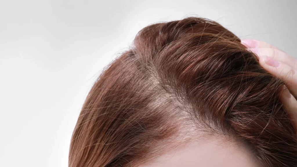 Hair Regrowth After Stress