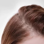 Hair Regrowth After Stress