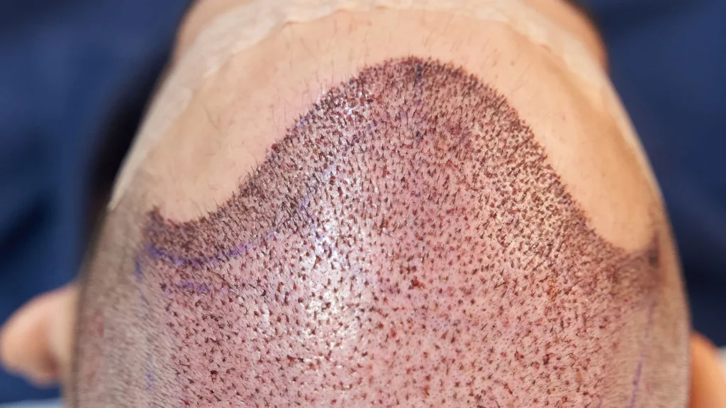 how to Sleep After a Hair Transplant