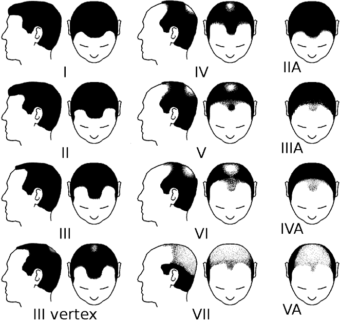 The Norwood Scale -To Measure Hair Loss