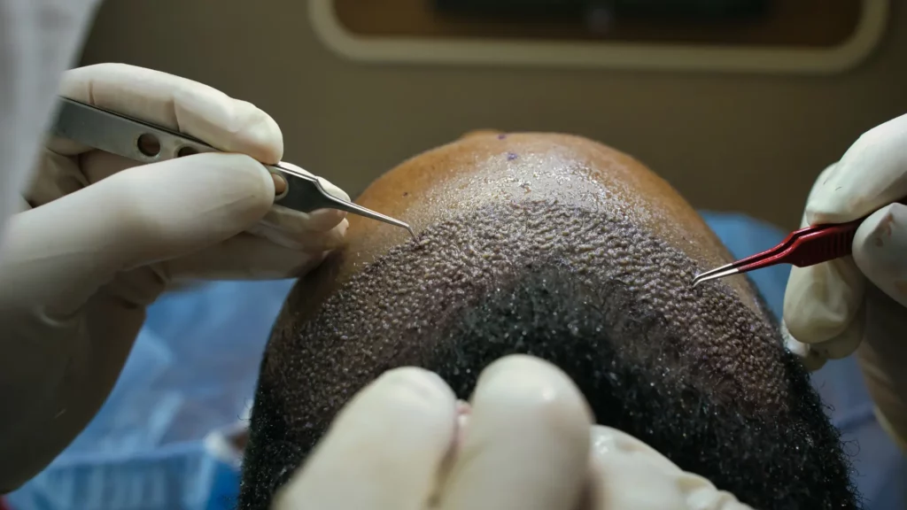 Hair Transplants