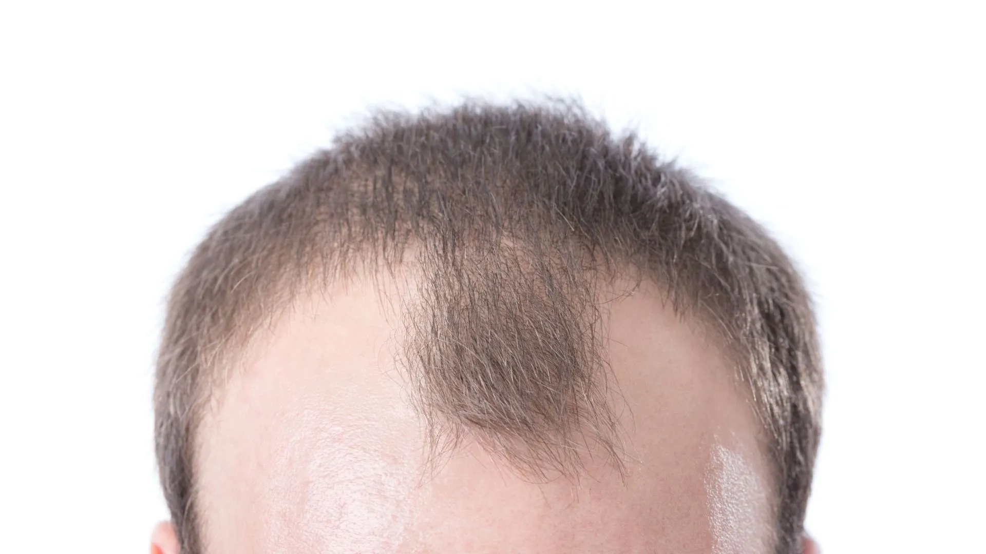 How To Hide Receding Hairline sep 10 Ways To Cover It Up