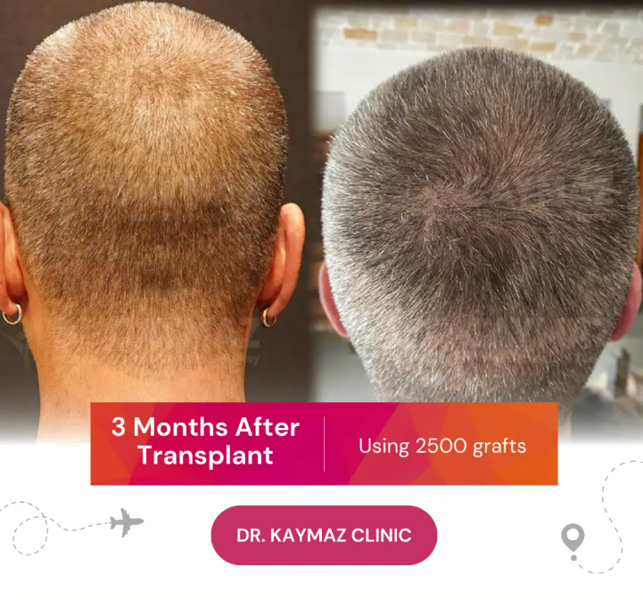 3 Months After Hair Transplant
