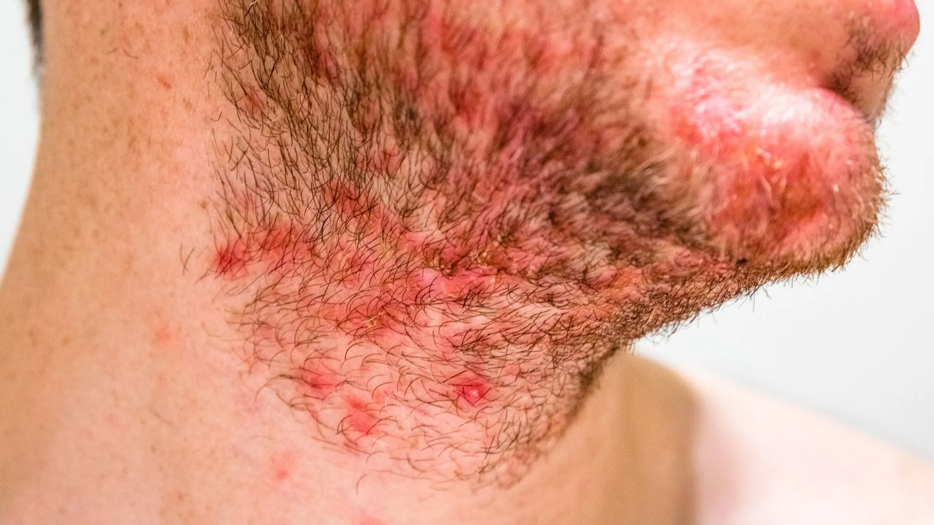 how to treat folliculitis after hair transplant