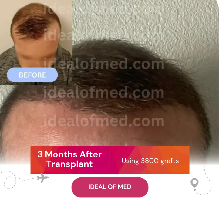 3 Months After Hair Transplant