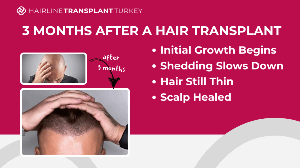 3 months after hair transplant - here is what to expect at the 3 month mark after your hair transplant