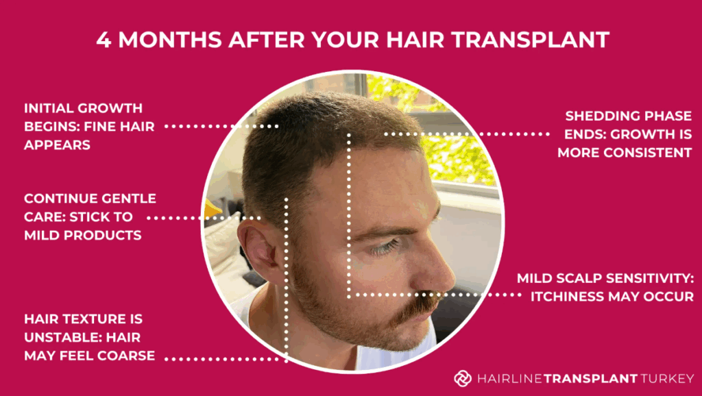 4 Months After Your Hair Transplant What to Expect