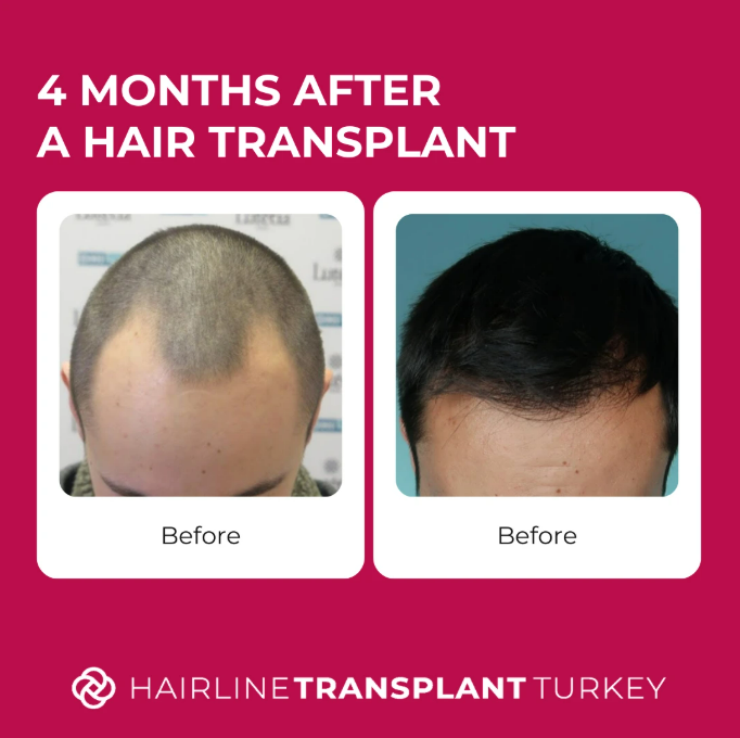 4 months after hair transplant - here is what to expect at the 4 month mark after your hair transplant chekc outstanding before and after pictures