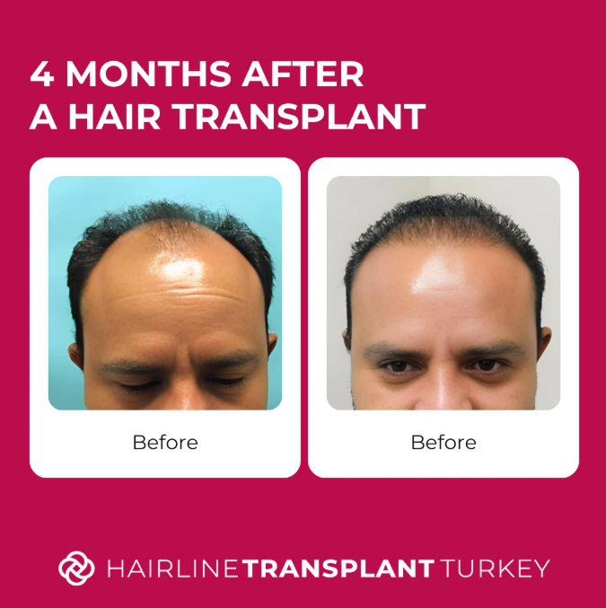 4 months after hair transplant - here is what to expect at the 4 month mark after your hair transplant check outstanding before and after pictures