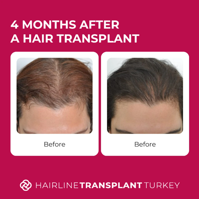 4 months after hair transplant - here is what to expect at the 4 month mark after your hair transplant check outstanding before and after pictures