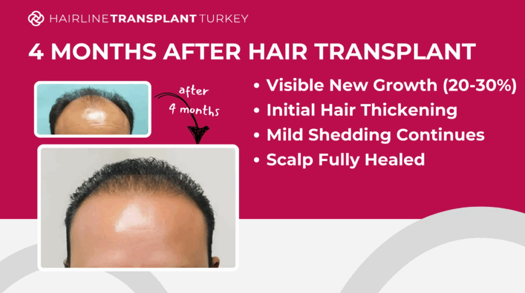 4 months after hair transplant - here is what to expect at the 4 month mark after your hair transplant