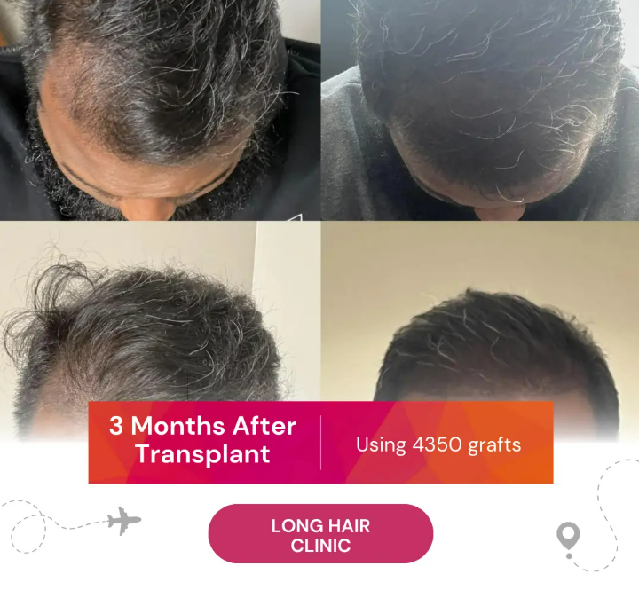 3 Months After Hair Transplant