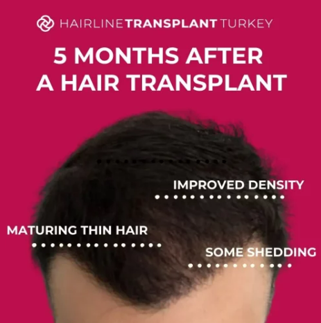 5 Months After A Hair Transplant Result