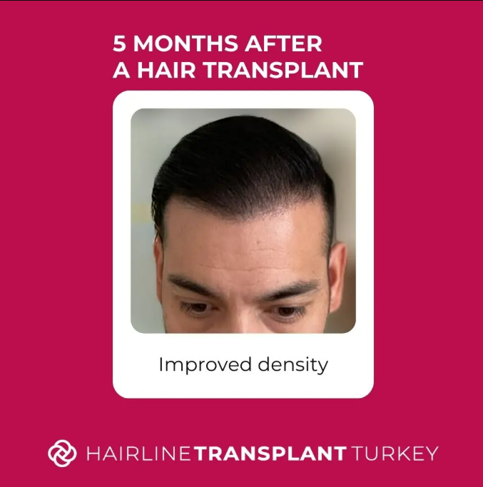 5 months after hair transplant density