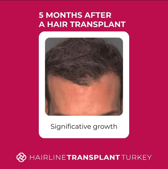 5 months after hair transplant growth