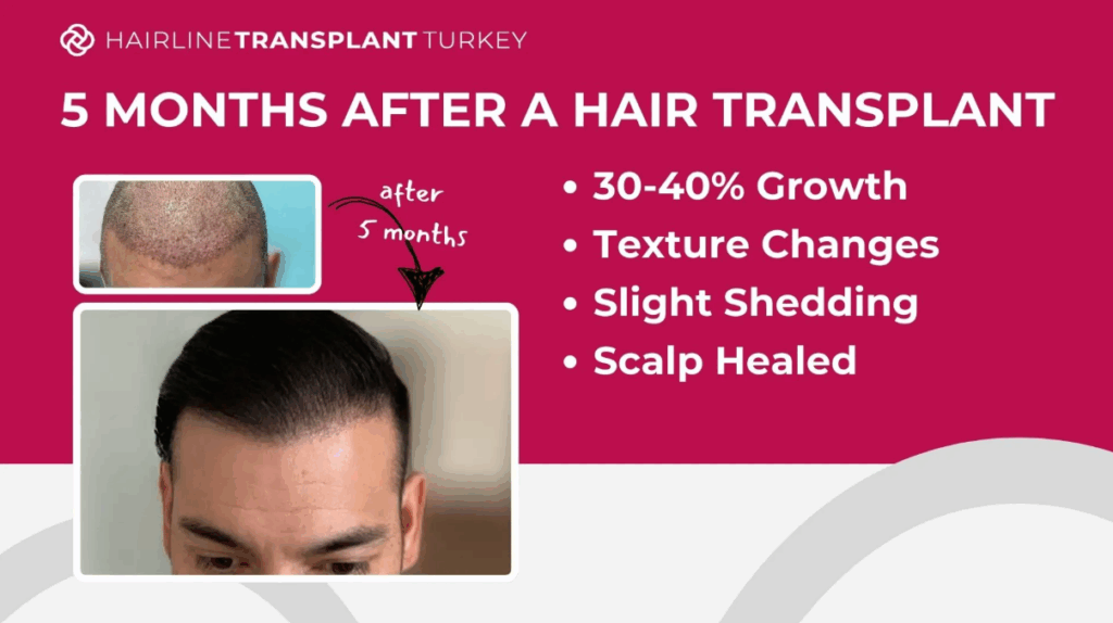 5 months after hair transplant - here is what to expect at the 5 month mark after your hair transplant