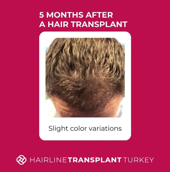 5 months after hair transplant result