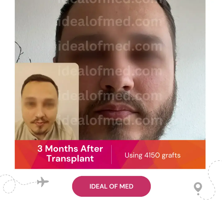 3 Months After Hair Transplant