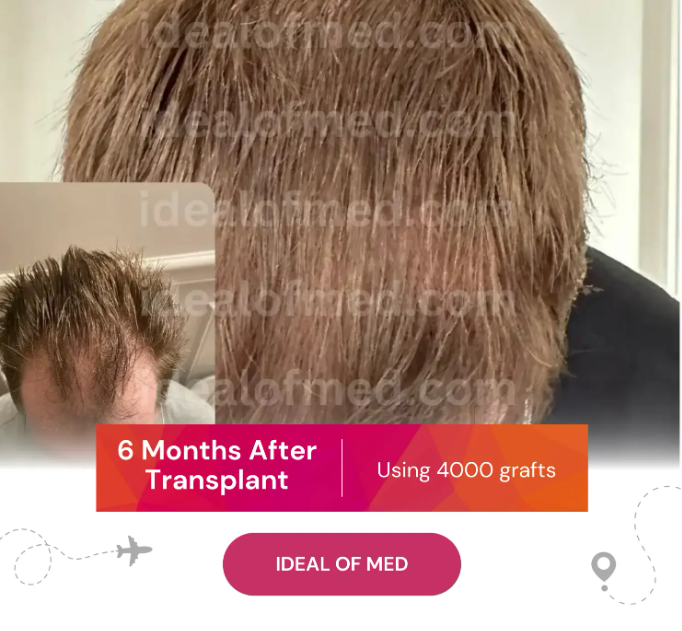 6 Month After Hair Transplant