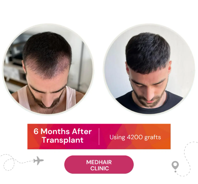 6 Month After Hair Transplant