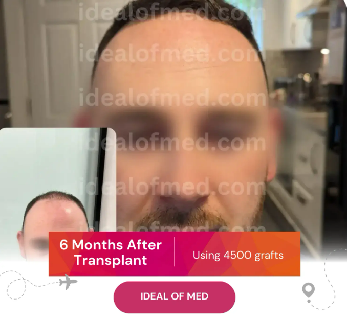 6 Month After Hair Transplant