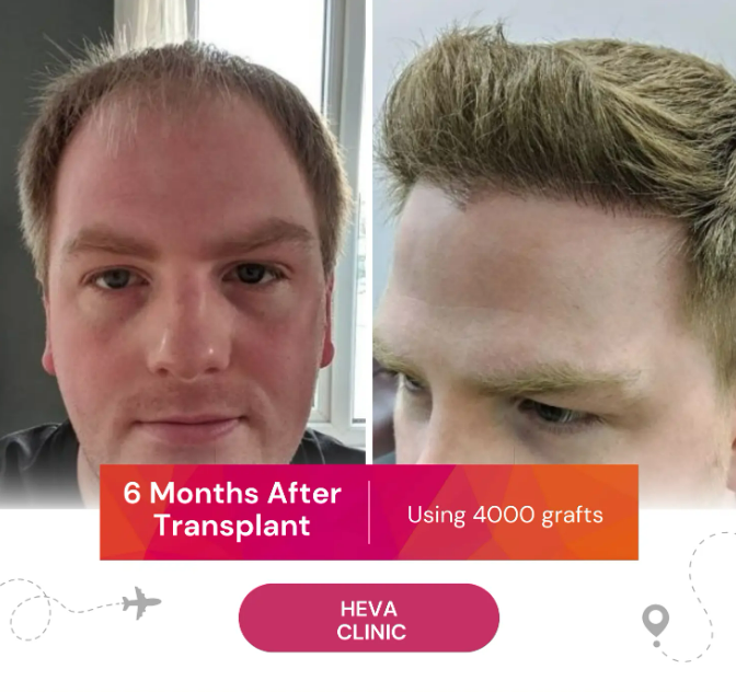 6 Month After Hair Transplant