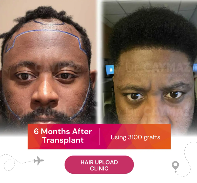 6 Month After Hair Transplant
