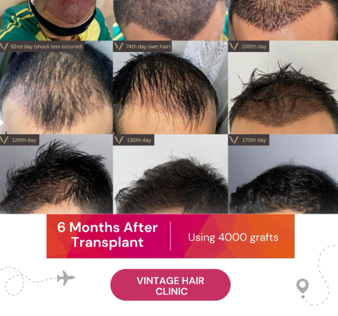 6 Month After Hair Transplant