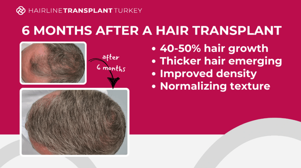 6 months after hair transplant - here is what to expect at the 6 month mark after your hair transplant