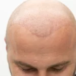 direct hair implantation