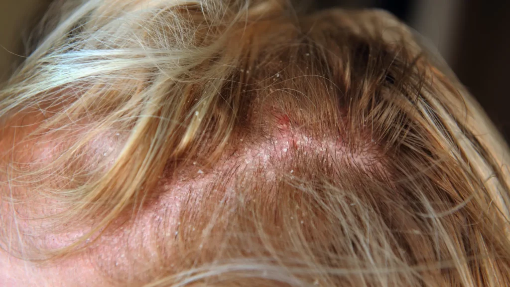 Seborrheic dermatitis