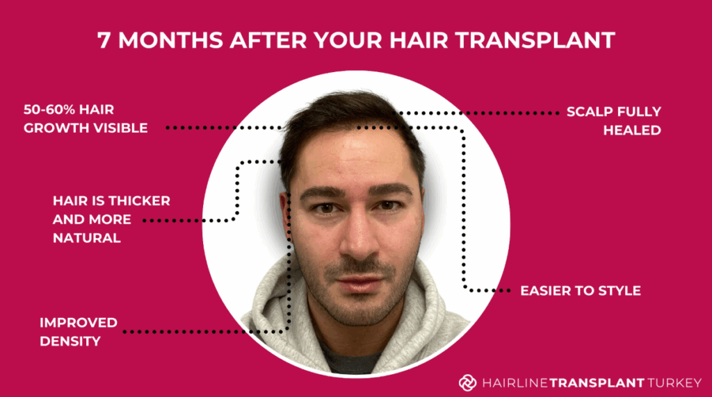 7 months after hair transplant - here is what to expect at the 7 month mark after your hair transplant