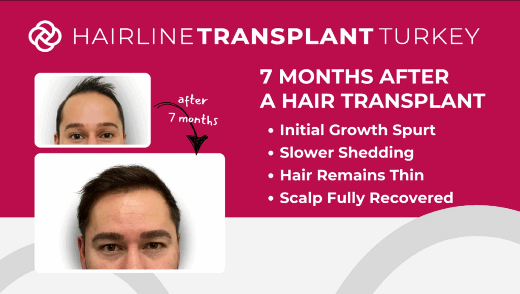 7 months after hair transplant - here is what to expect at the 7 month mark after your hair transplant