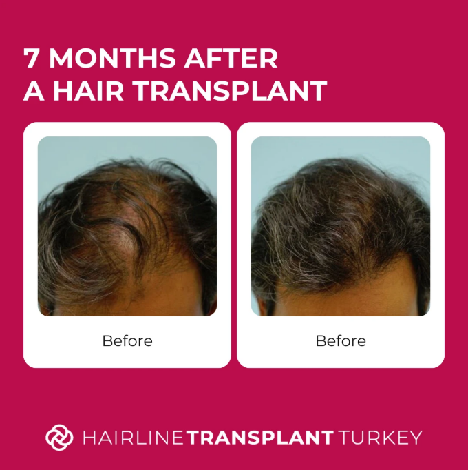 7 months after hair transplant - here is what to expect at the 7 month mark after your hair transplant patient 2 impressive before and after pictures