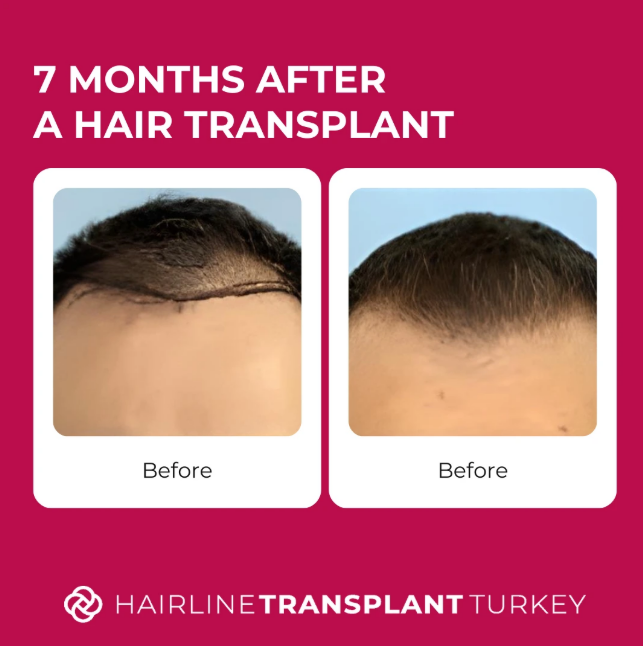 7 months after hair transplant - here is what to expect at the 7 month mark after your hair transplant patient 2 impressive before and after pictures
