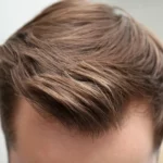 Hair transplant in Australia