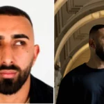 ibby akbar hair transplant news